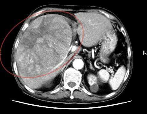 1名80多歲的老先生過去沒有慢性病史，肝臟長出15公分大的腫瘤。（示意圖／翻攝自錢政弘 胃腸肝膽科醫師臉書）