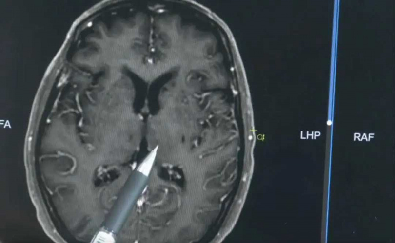 豬鏈球菌為豬隻常見病原體，養殖與屠宰過程中若手部有傷口，恐增加感染風險。