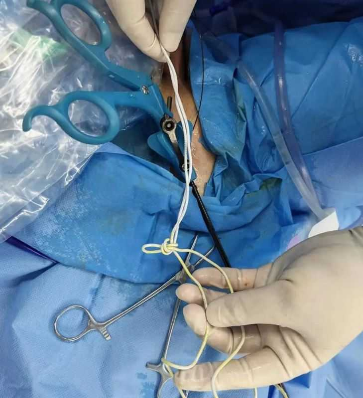男子將1條長約25公分的傳輸線塞入尿道，結果整條線滑入體內，無法自行取出。（圖／翻攝自南方都市報）