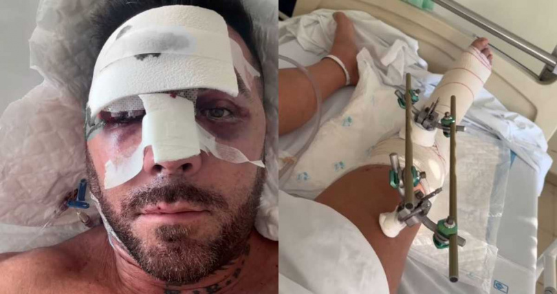 這場墜機事故導致哈維的頭骨、脊椎等多處骨折。（圖／翻攝自Instagram／@xavi.caballol）