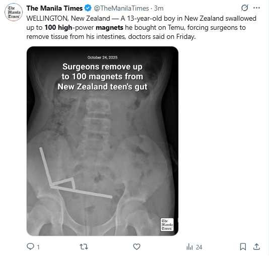 13歲男童吞下近百顆高強力磁鐵,歷經開刀手術切除部分腸道後順利康復出院。(圖/翻攝自X,@TheManilaTimes)