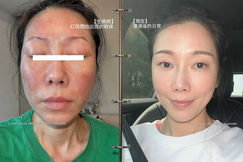 KIMIKO大方分享自己嚴重過敏反應的樣子。(圖/翻攝自臉書/KIMIKO)