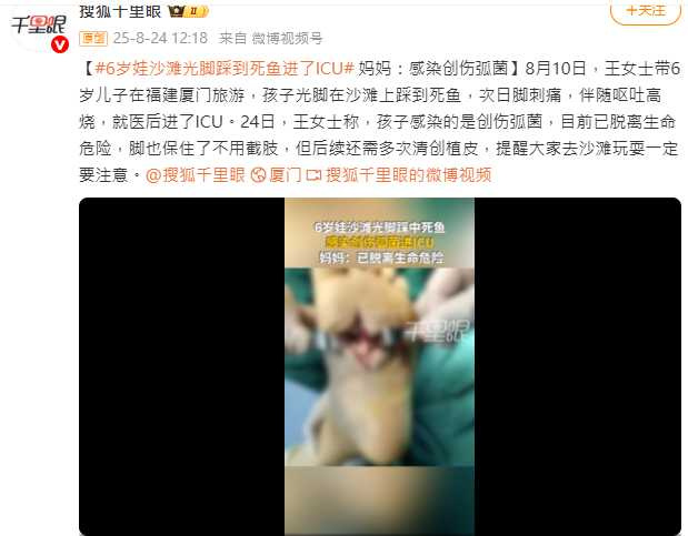 專家提醒，家長應避免孩子光腳在沙灘奔跑，以降低感染風險。（圖／翻攝自微博， 搜狐千里眼 ）