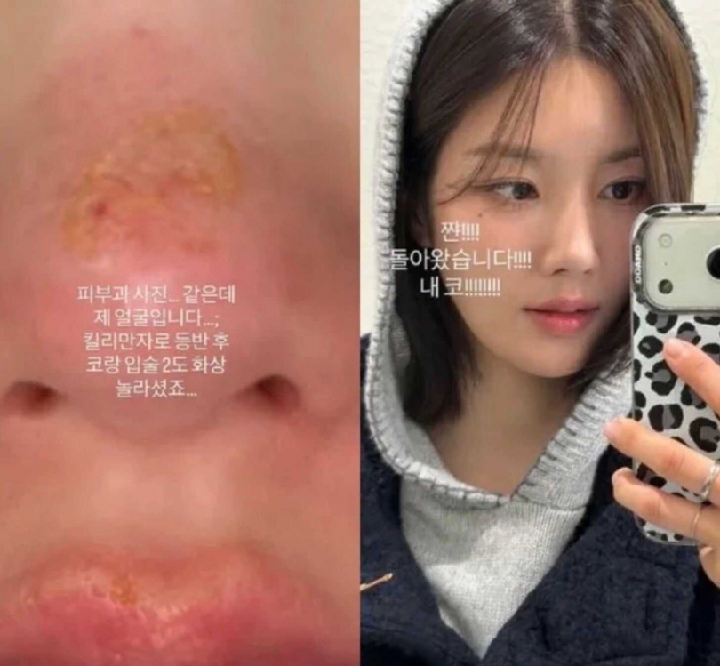 權恩妃近期去吉力馬札羅山登山，卻因超強紫外線曬傷臉，鼻子和嘴唇2度燒傷。（圖／翻攝自Instagram／silver_rain.__）