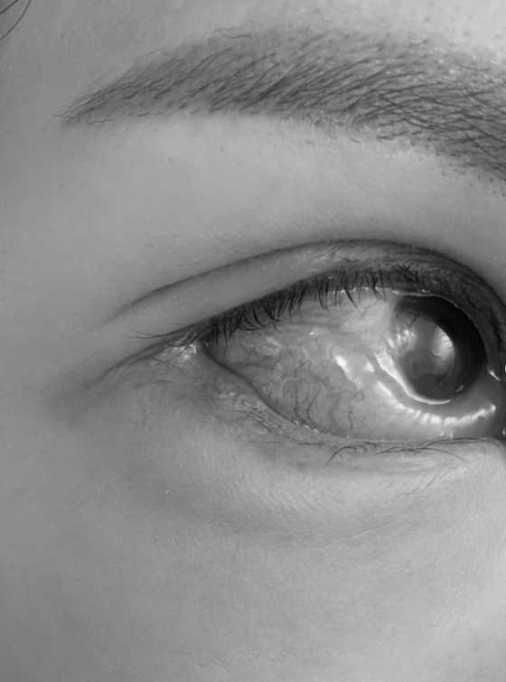 Lala的眼白腫脹，布滿血絲。（圖／翻攝自IG／lalababy625）