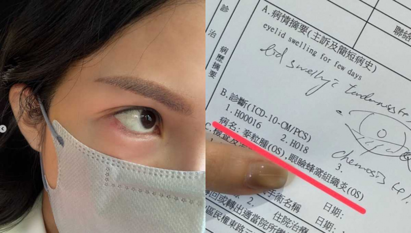 Lala的小針眼惡化成眼瞼蜂窩組織炎。（圖／翻攝自IG／lalababy625）