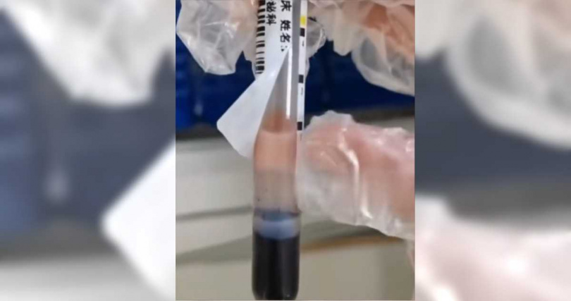 孕婦的三酸甘油脂嚴重超標，血液如「草莓奶昔」。（圖／翻攝自九派新聞）
