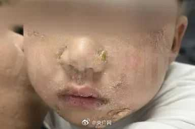 男童就醫檢查發現罹患「葡萄球菌燙傷樣皮膚症候群」。（圖／翻攝自微博）