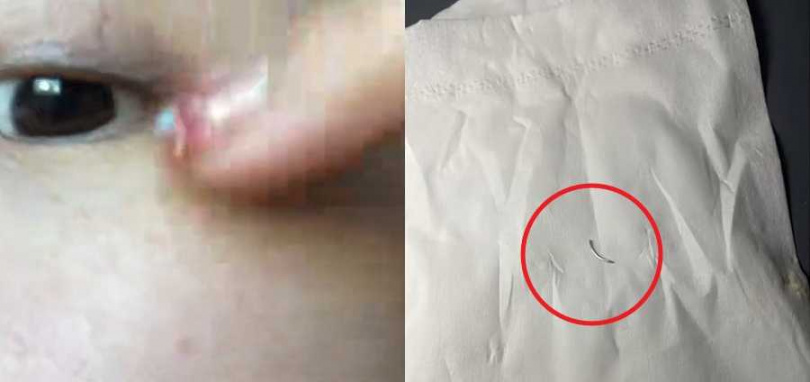 大陸河南一名顧姓女子2020年去做埋線式雙眼皮手術，怎料，醫師竟把手術的針留在她的眼皮裡，直到近期她從眼尾揉出才發現。（圖／翻攝自微博）