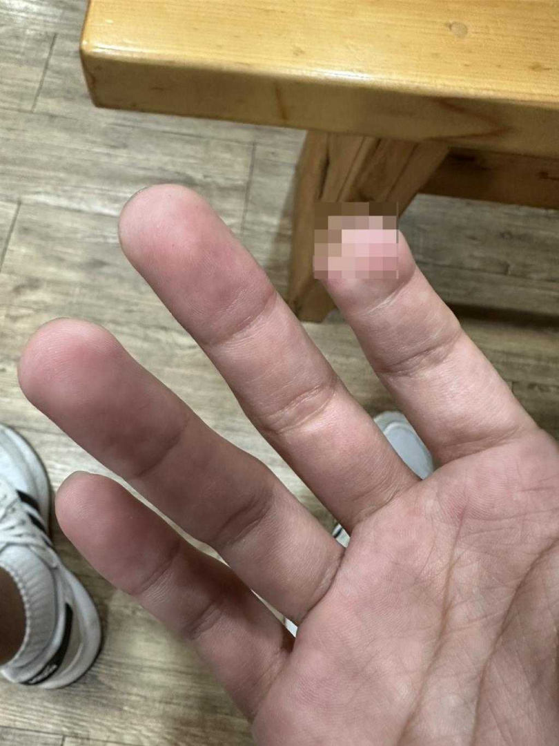 這起事故造成王員右手食指第貳指創傷性截肢、全身多處擦挫傷。（圖／翻攝畫面）