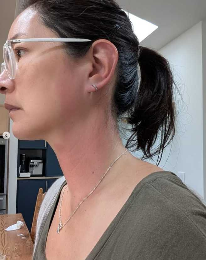 Janet的耳朵到胸口整片紅腫。（圖／翻攝自Instagram@janetagram）