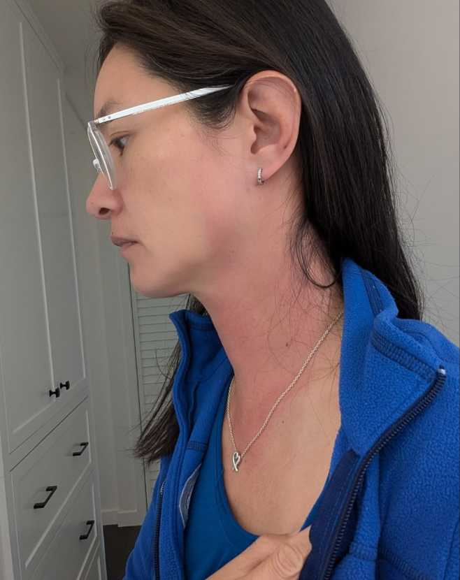 Janet的耳朵到胸口整片紅腫。（圖／翻攝自Instagram@janetagram）