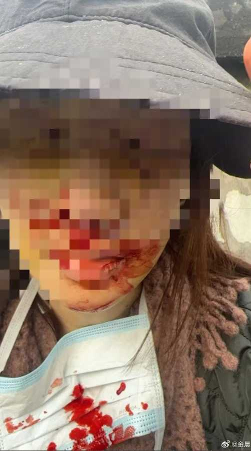 金晨發聲還原車禍當日狀況，並曬出自己滿臉是血的傷勢照。（圖／翻攝自金晨微博）