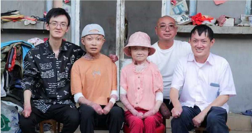 病魔纏身多年，宋冉冉的手指逐漸粘連並反覆潰爛，生活極為艱辛。（圖／翻攝自裕豐娛間說）