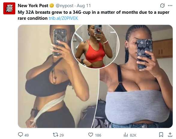 南非女子米雪兒因巨乳症胸圍暴增至34G，生活與心理都受到影響（圖／翻攝自X，@nypost）