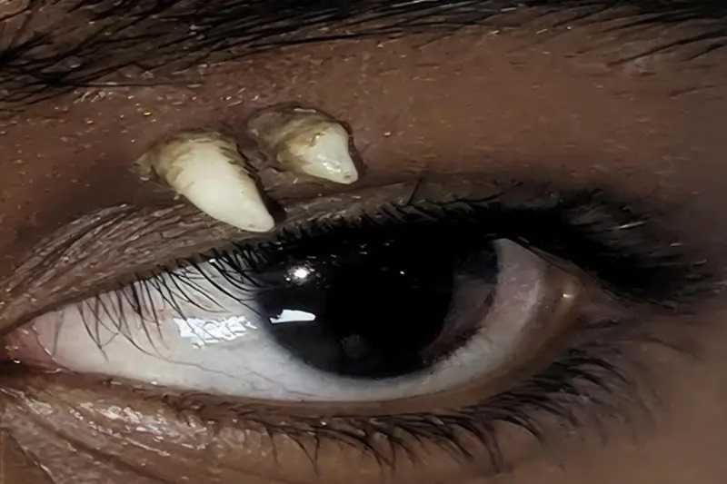 少年眼皮與眉毛之間冒出2個白色尖銳突起，醫師起初一度懷疑是罕見腫瘤。（圖／翻攝自American Academy of Ophthalmology）