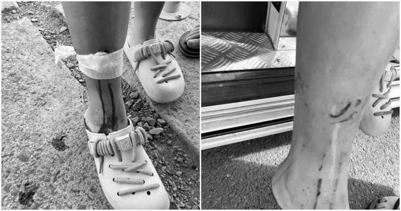 2024年2月,台南一名女子在屏東某水豚園區遊玩時,曾遭到水豚咬傷右小腿,事後還得了蜂窩性組織炎。(圖/翻攝Dcard)