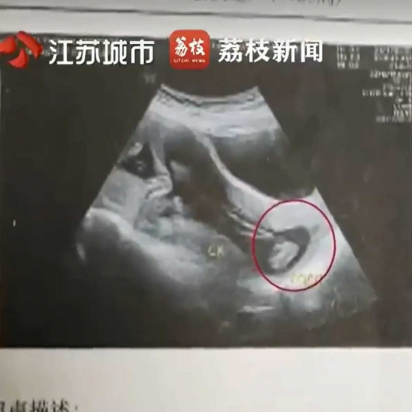 當時胎兒已經一腳伸出子宮,出現在陰道內。(圖/翻攝自微博)