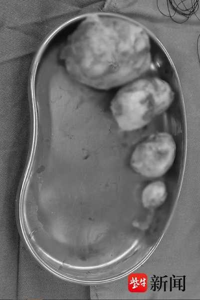 鄭女進行剖腹產，並順利將肌瘤摘除。（圖／翻攝自揚子晚報）