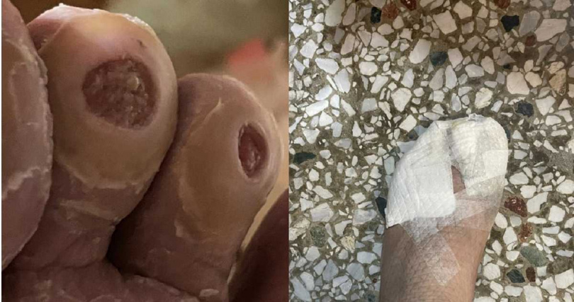 花蓮光復發生洪災至今邁入第17天,站在救災第一線的大安村長徐振雄因幫助村民清理家園,四處奔忙,最後腳趾磨破到快見要骨,經昨天求診已將傷口包紮。(圖/大安村長徐振雄提供)