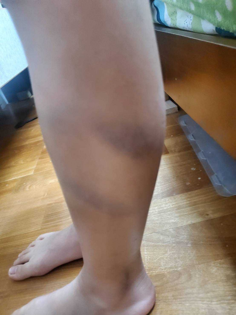 魏筠指出，某補習班有一名情緒失控的謝姓老師曾毆打學童至全身瘀傷。（圖／林月琴辦公室提供）