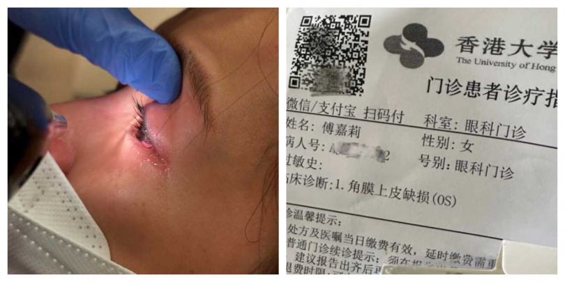 眼傷惡化後再度送院,傅嘉莉透露眼痛劇烈、眼紅腫流淚,情況一度危急。(圖/擷取自IG,@kelly.fuu)