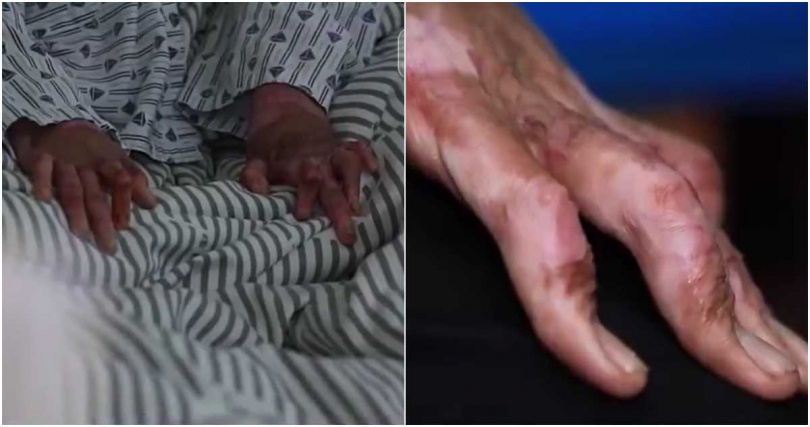 大陸吉林省一名18歲青少年小鄭在吸食打火機氣體「丁烷」時，不慎發生霸炸，導致他嚴重燒燙傷，儘管送醫後幸運救回一命，但小鄭的手指卻再也無法伸直。（圖／翻攝自CCTV）