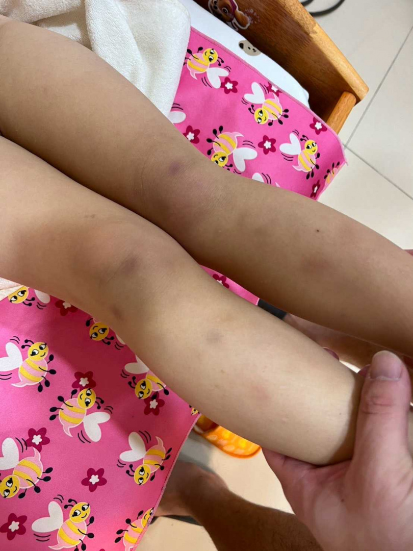 受害家長在今年2月孩童下課後,發現孩子腳上遍布點狀瘀青。(圖/受害家長提供)