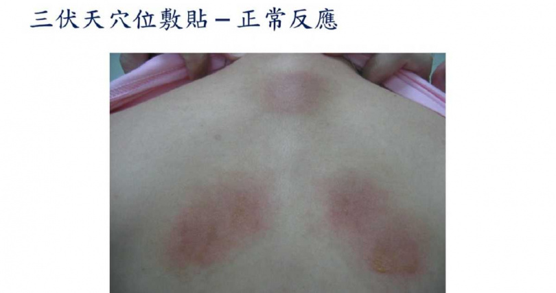 三伏貼穴位敷貼正常反應。(圖/張晉賢提供)