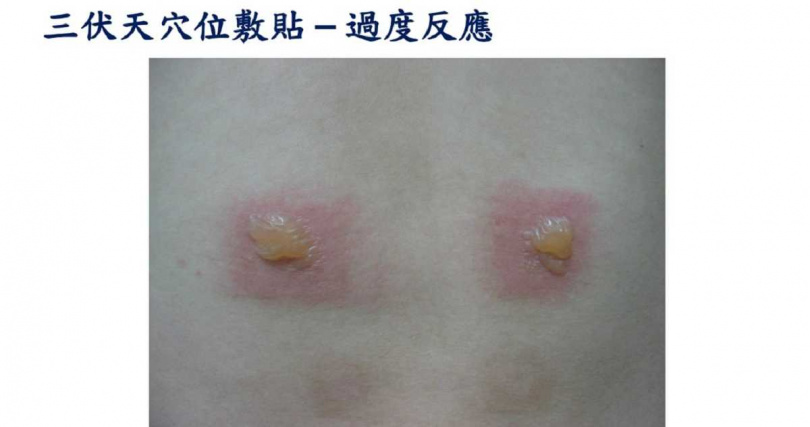 三伏貼穴位敷貼過度反應。(圖/張晉賢提供)