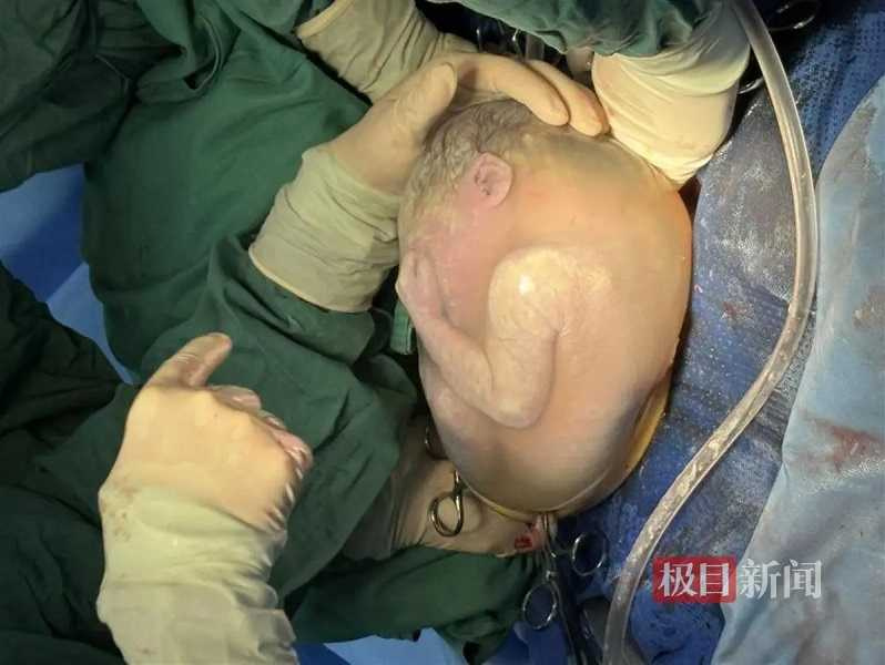 醫護團隊利用保留胎膜囊剖宮產術，讓「蛋寶寶」順利出世。。（圖／翻攝自極目新聞）