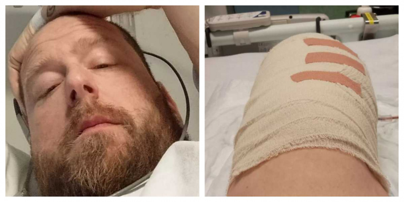 Mike Jones 手術後於病床上自拍，目前正努力適應截肢後的生活節奏。（圖／Mike Jones 提供）