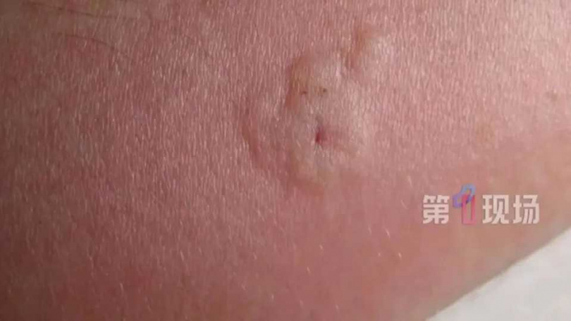 男童的額頭、脖子和手臂上都有蜜蜂的毒刺。（圖／翻攝自第一現場）
