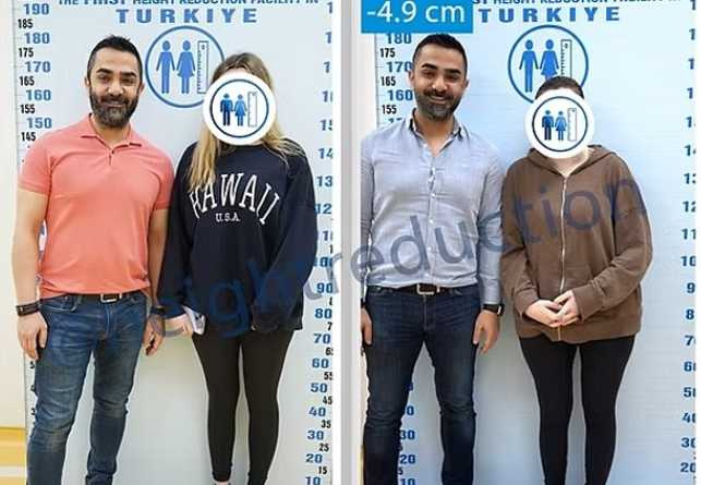 土耳其整形診所推出縮高手術，透過切除腿骨來縮短身高。（圖／Height Reduction Clinic 提供）