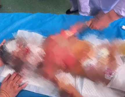 1歲童因養生壺爆炸,全身40%大面積燙傷。(圖/翻攝自微博/新京報)