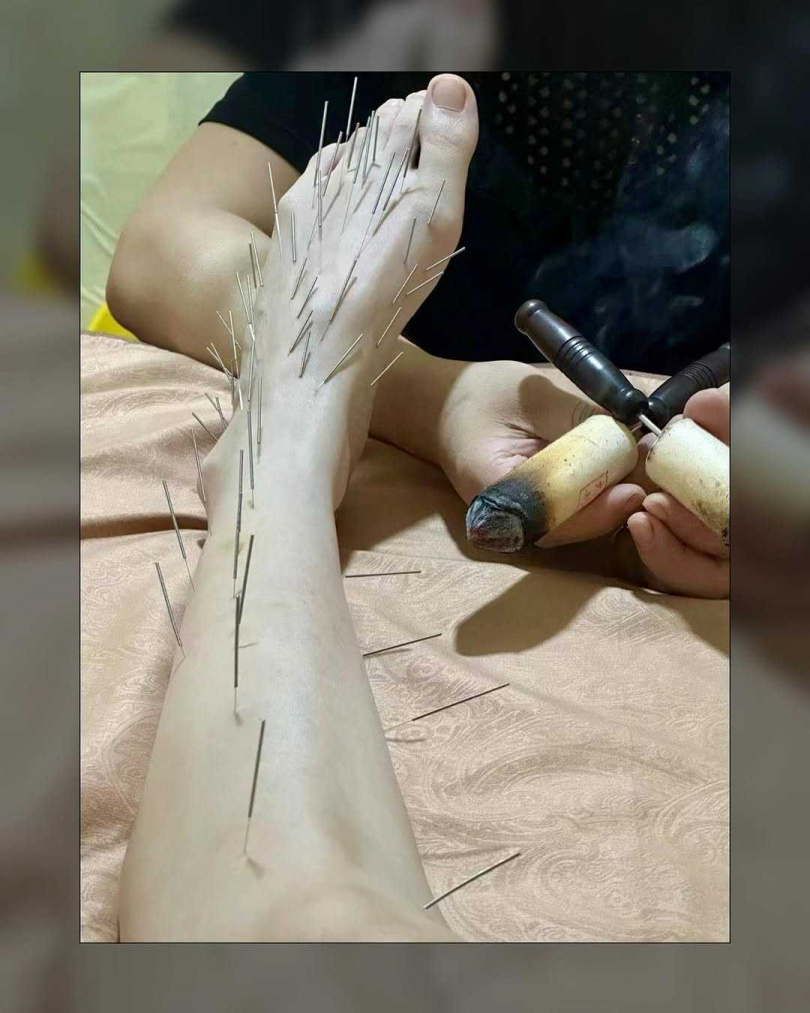 陳喬恩為了保養、活化氣血，透過針雕保養。（圖／陳喬恩IG）