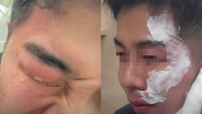 「一生叔叔」右半臉紅腫送醫治療。（圖／翻攝自一生叔叔-Eason臉書）