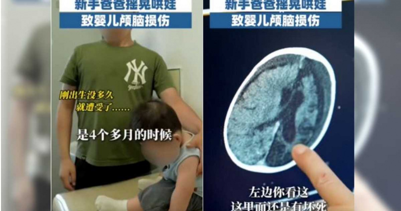 幼童部分腦組織壞死。(圖/翻攝自微博/山海視頻)