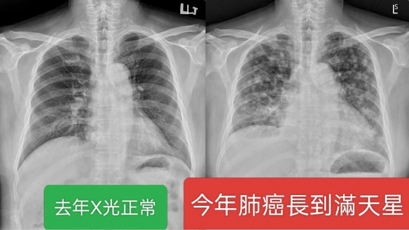 男子去年X光正常,今年竟轉移變末期。(圖/翻攝自蘇一峰臉書)