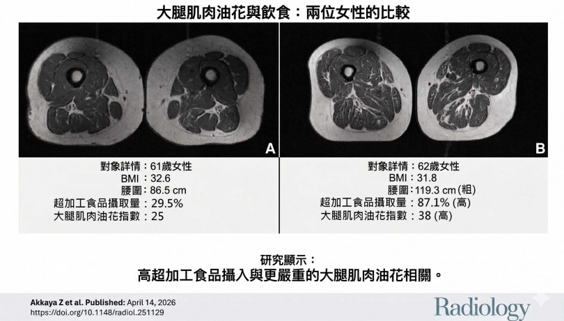最新研究顯示，攝取超加工食品越多，大腿肌肉脂肪浸潤就越明顯。（圖／翻攝自臉書／蔡明劼醫師 健康。瘦身）