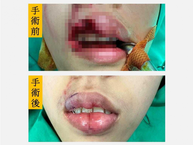 台中市20歲張姓女子遭愛犬咬傷上脣，造成3分之1缺損而破相，仁愛長庚合作聯盟醫院整形外科醫師楊佳叡擬定3階段手術重建修復，助少女重拾笑容與自信。（圖／仁愛長庚合作聯盟醫院）