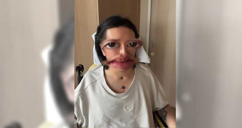 阿Mo於7月時曬出正面照，頸部下方清楚可見插管的傷口。（圖／翻攝自Instagram／momo.lky）