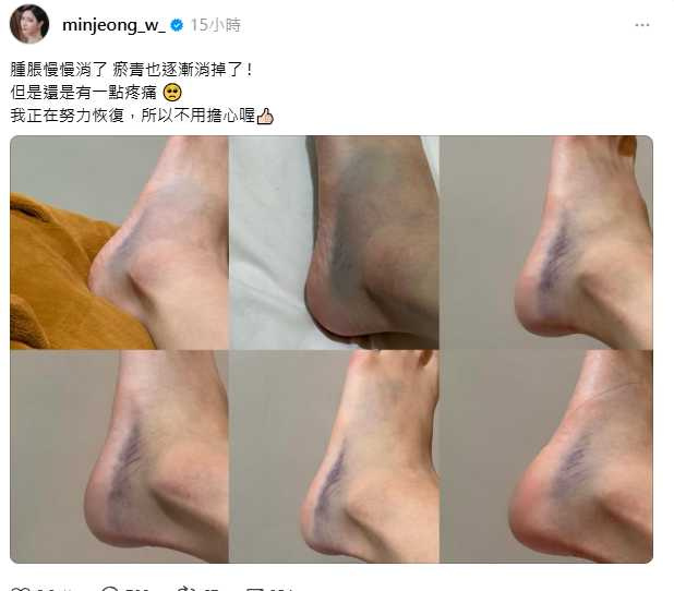 南珉貞在社群平台分享腳傷近況,腳背瘀青明顯,讓粉絲相當擔心。(圖/翻攝自 Threads,minjeong_w_)