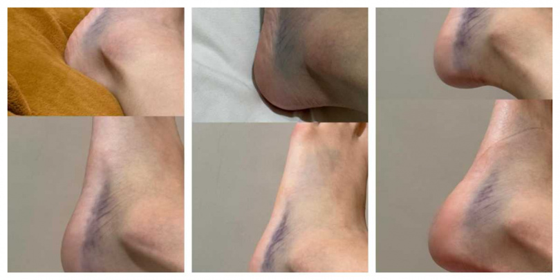 南珉貞在社群平台分享腳傷近況,腳背瘀青明顯,讓粉絲相當擔心。(圖/翻攝自 Threads,minjeong_w_)