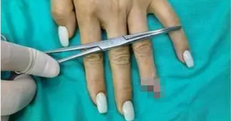 大陸一名女子的左手無名指意外被門夾到，當下她並未感到劇烈疼痛，沒想到竟驚見「手指頭斷了」。（圖／擷取自微博）