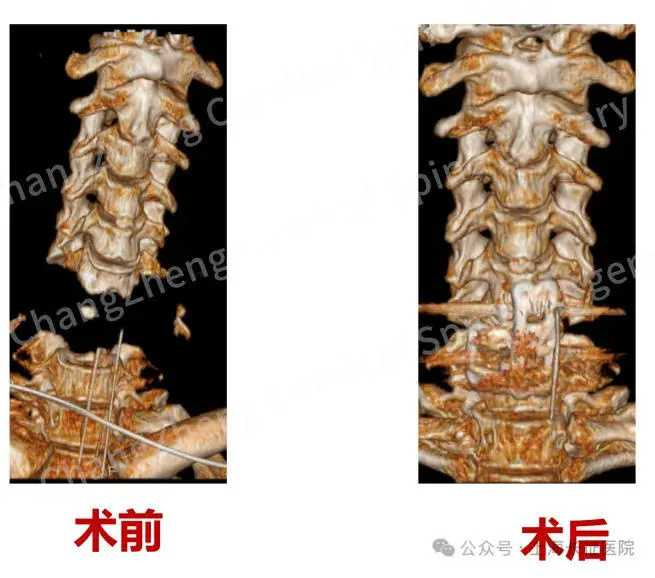 患者頸椎嚴重脫位，影像顯示如身首離斷，傷勢全球罕見。（圖／翻攝自微博， 頭條新聞）