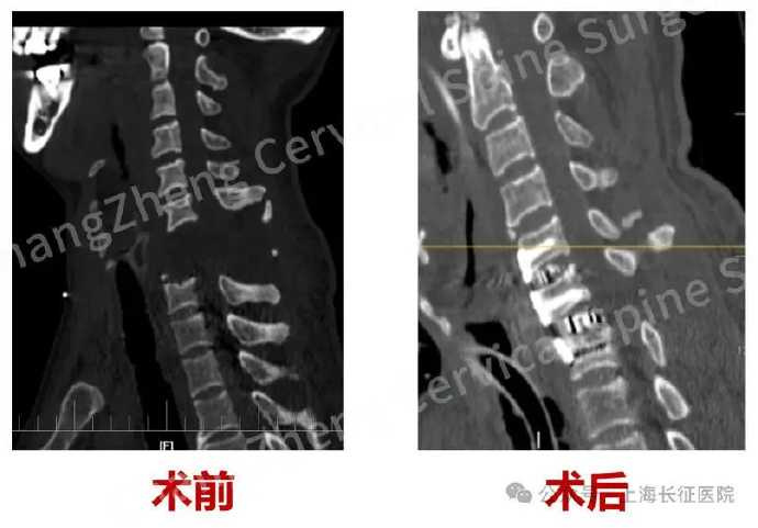 手術中應用特殊輔助鋼板固定技術，提供極高穩定性，全球首見。（圖／翻攝自微博， 頭條新聞）