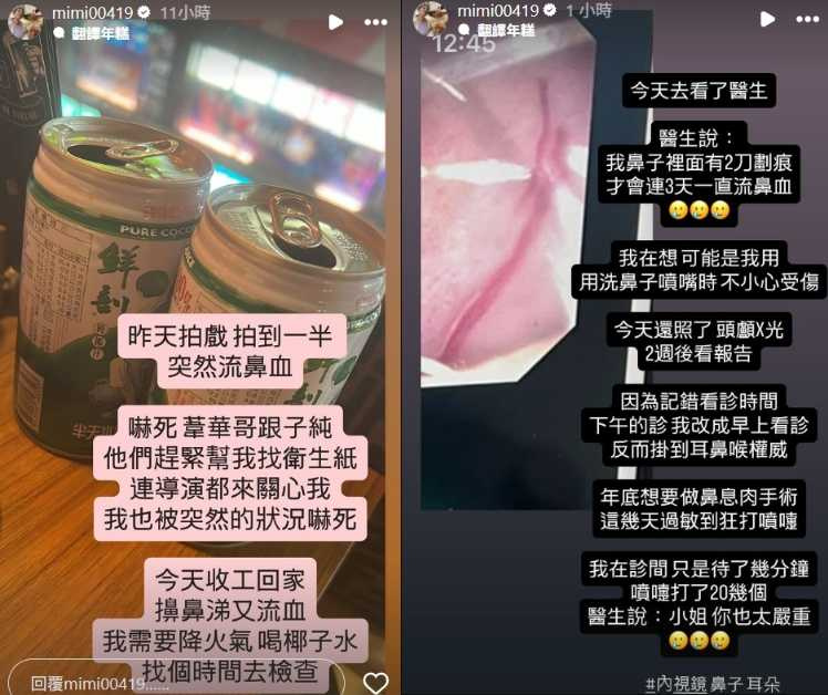 米可白連續3天流鼻血，就醫發現鼻子內有2刀劃痕，推測是洗鼻時被噴嘴誤傷，但也決定年底要做鼻息肉手術。（圖／翻攝自Instagram／mimi00419）