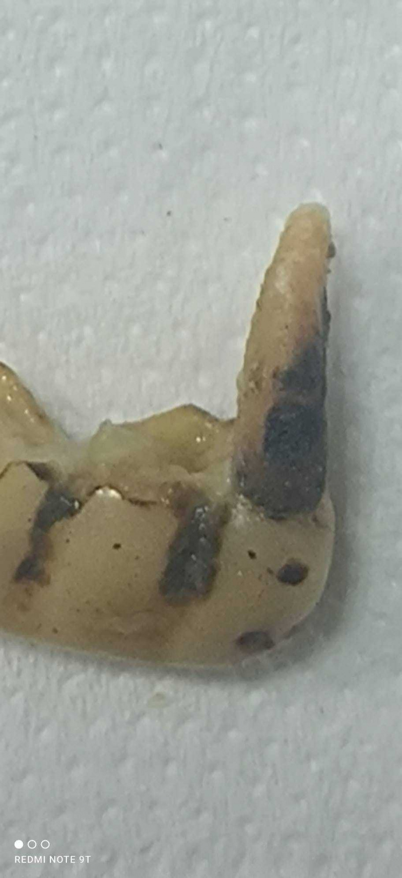 有民眾投訴吃水煎包吃到牙齒，牙醫表示是人的假牙。（圖／翻攝臉書／台東大小事）