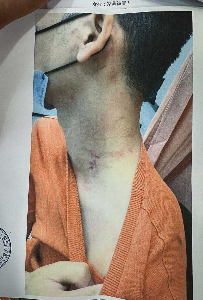 S先生的脖子上還可以看到紅痕，顯現出當時施暴者用力之大。（圖／S先生提供）